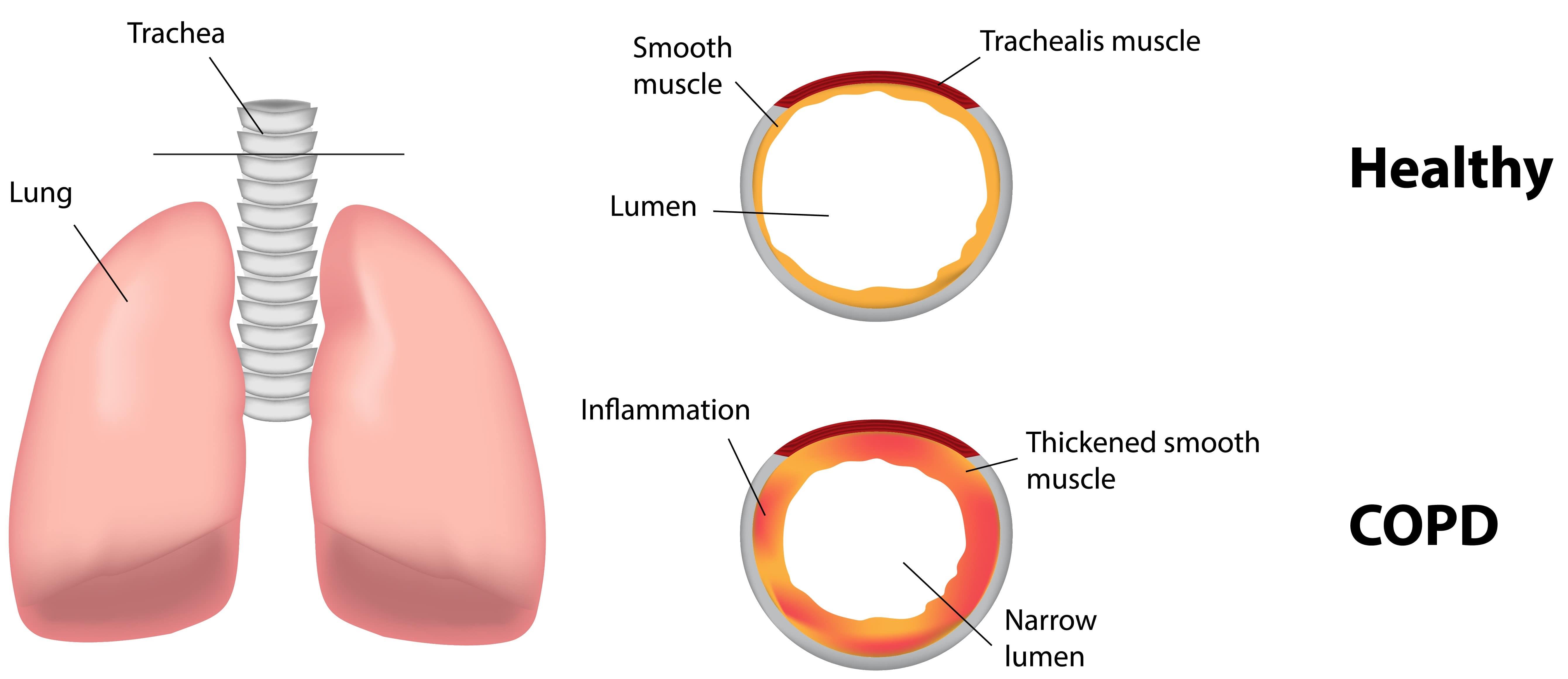 Symptoms Of Chronic Obstructive Pulmonary Disease